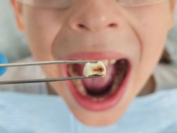 Best Knocked-Out Tooth Emergency  in Killian, LA
